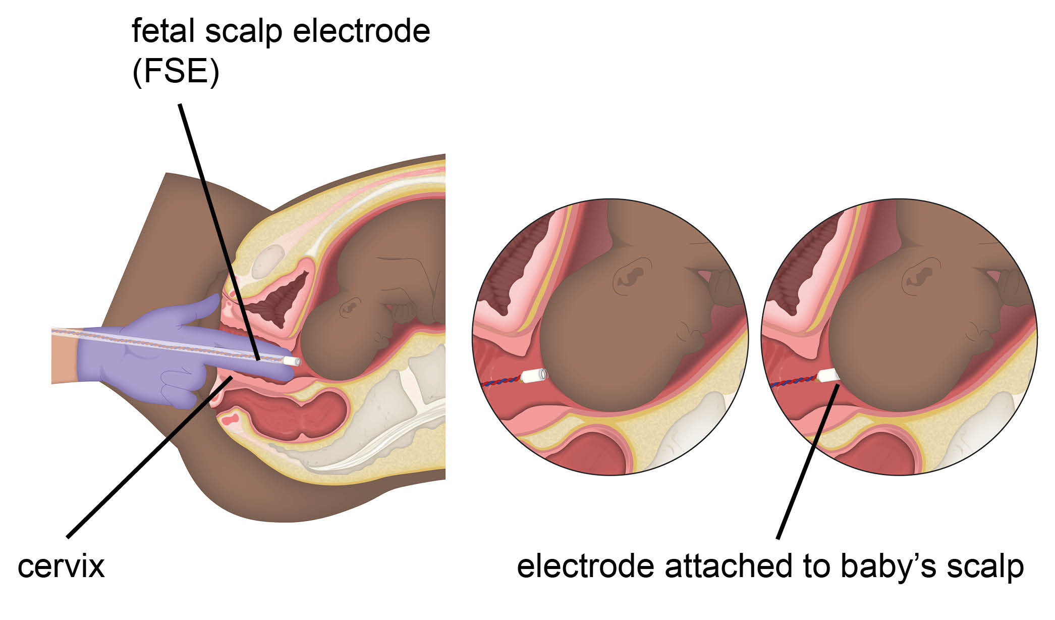Diagram showing the fetal scalp electrode attached to baby's scalp