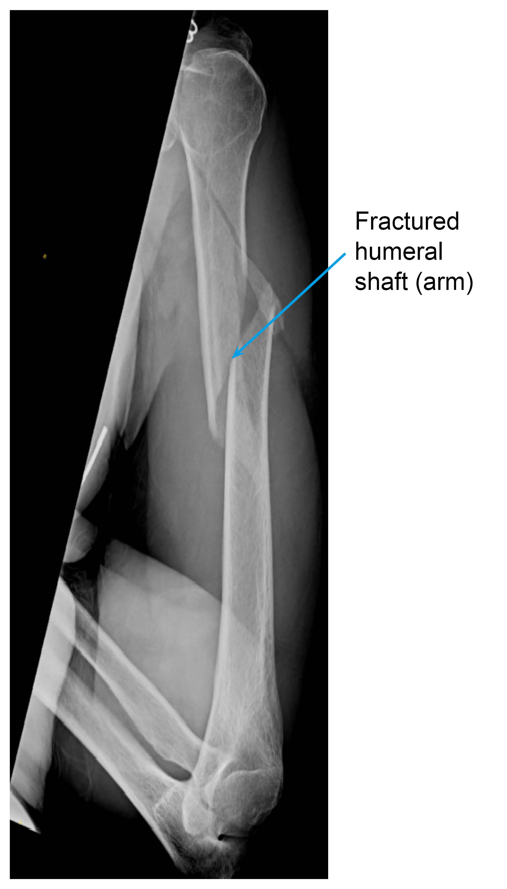 X-ray showing a fractured humeral shaft