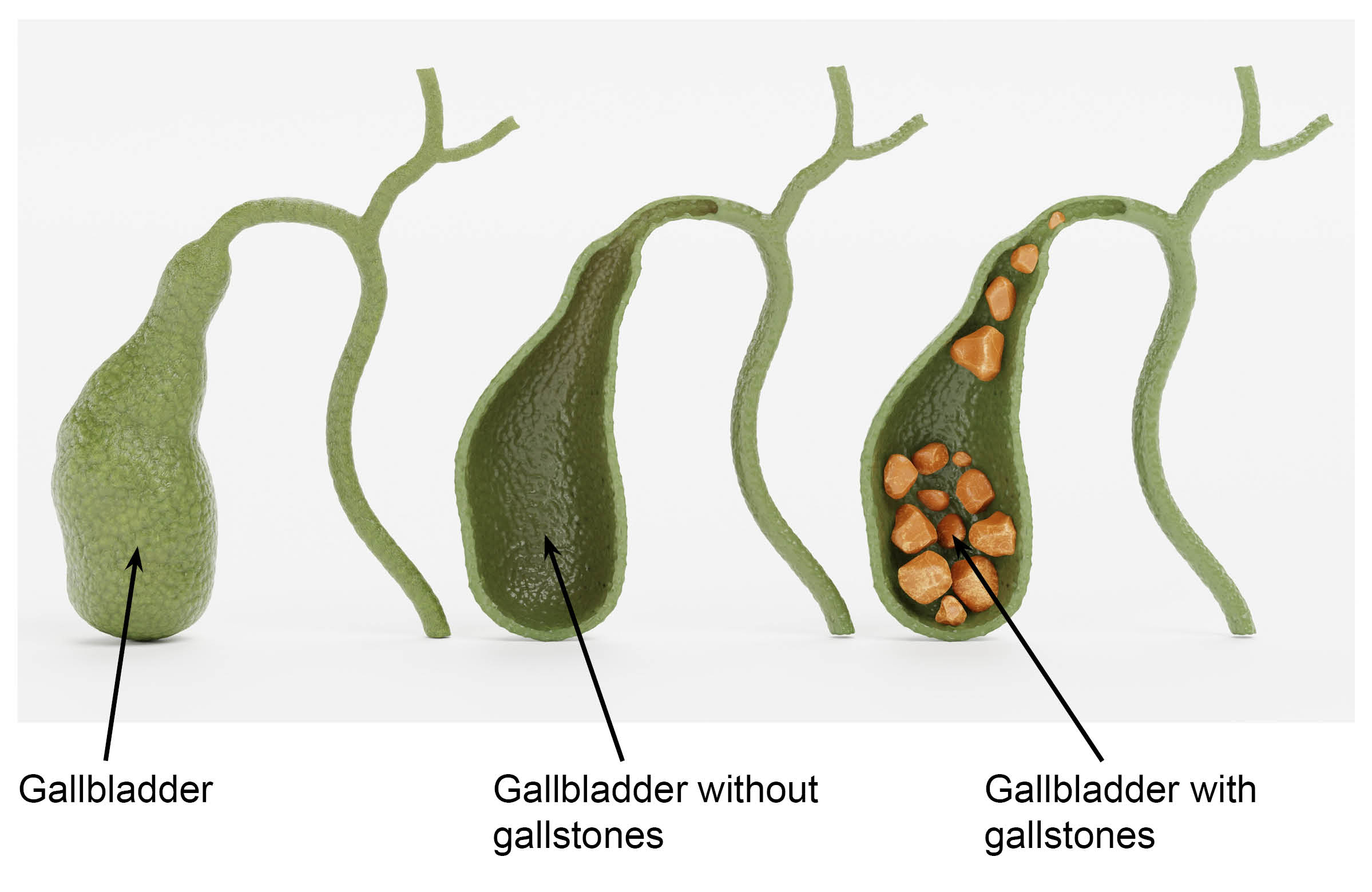 A photo of the gallbladder, a small green organ. The second photos shows the gallbladder cut in half, showing no gallstones inside. The third photos shows the gallbladder cut in half, containing 15 gallstones. The gallstones are light brown in colour and all different sizes.