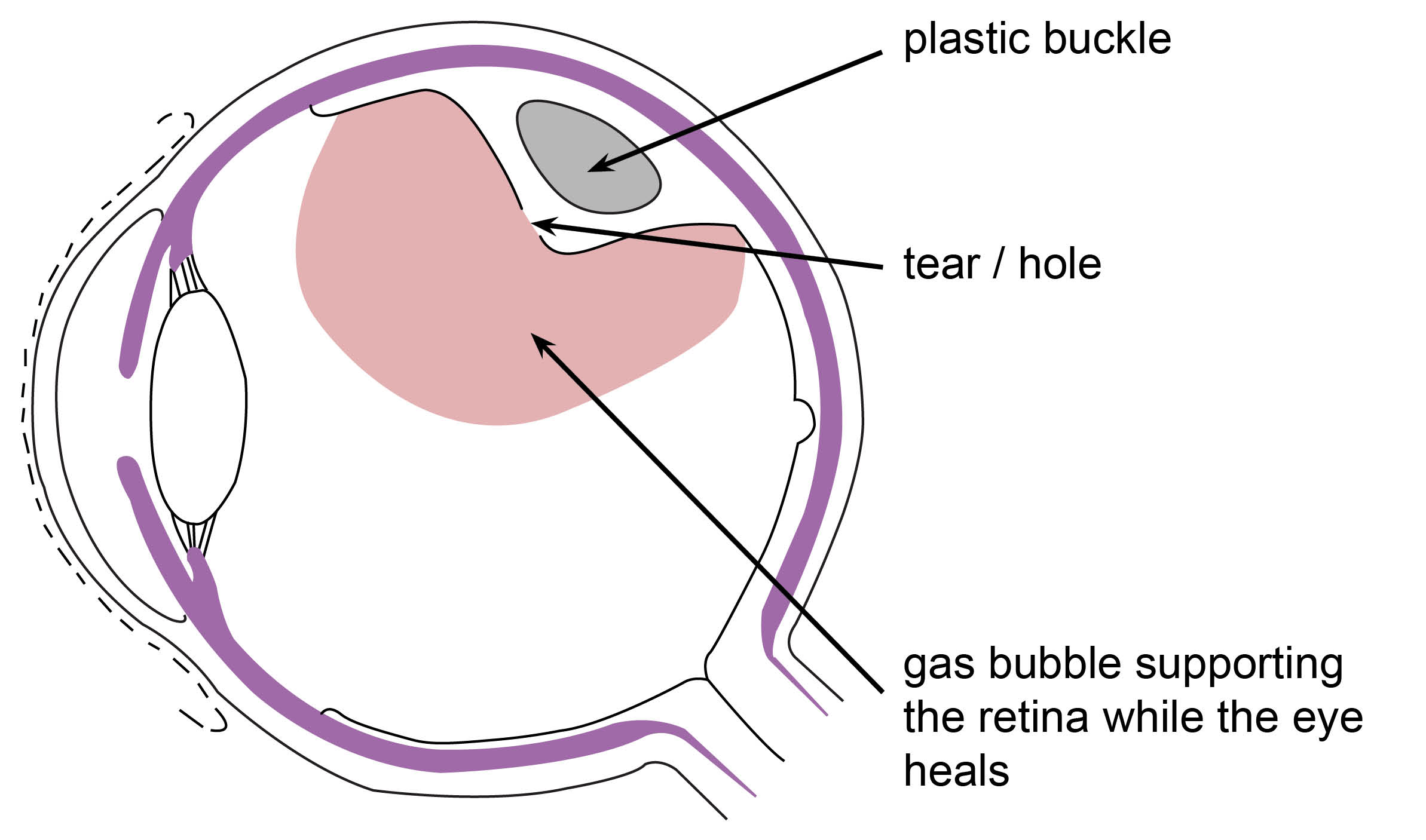 Diagram showing a tear / hole, with a gas bubble supporting the retina while the eye heals