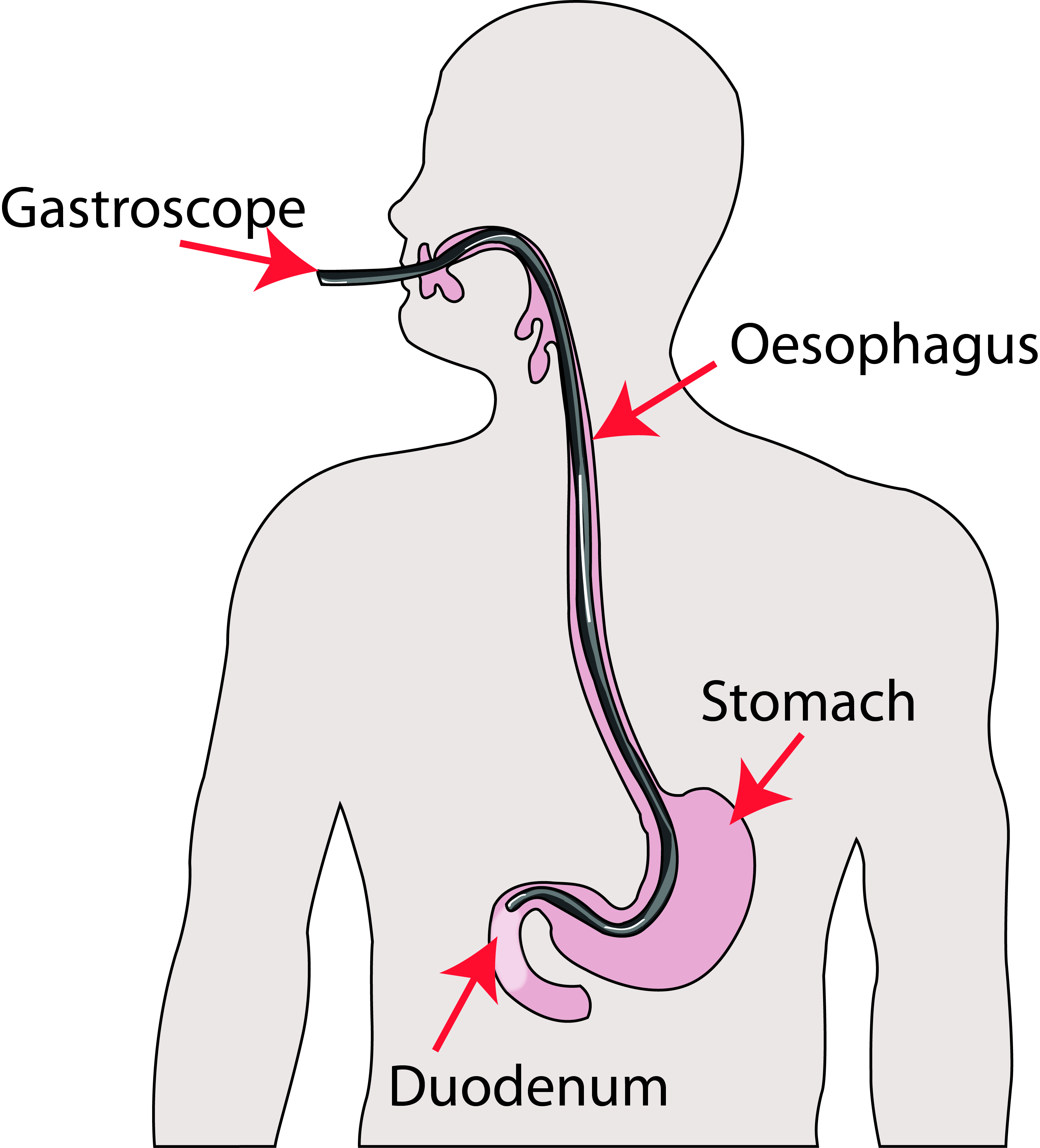 Gastroscope being passed through the patient's mouth, through their oesophagus and into their stomach