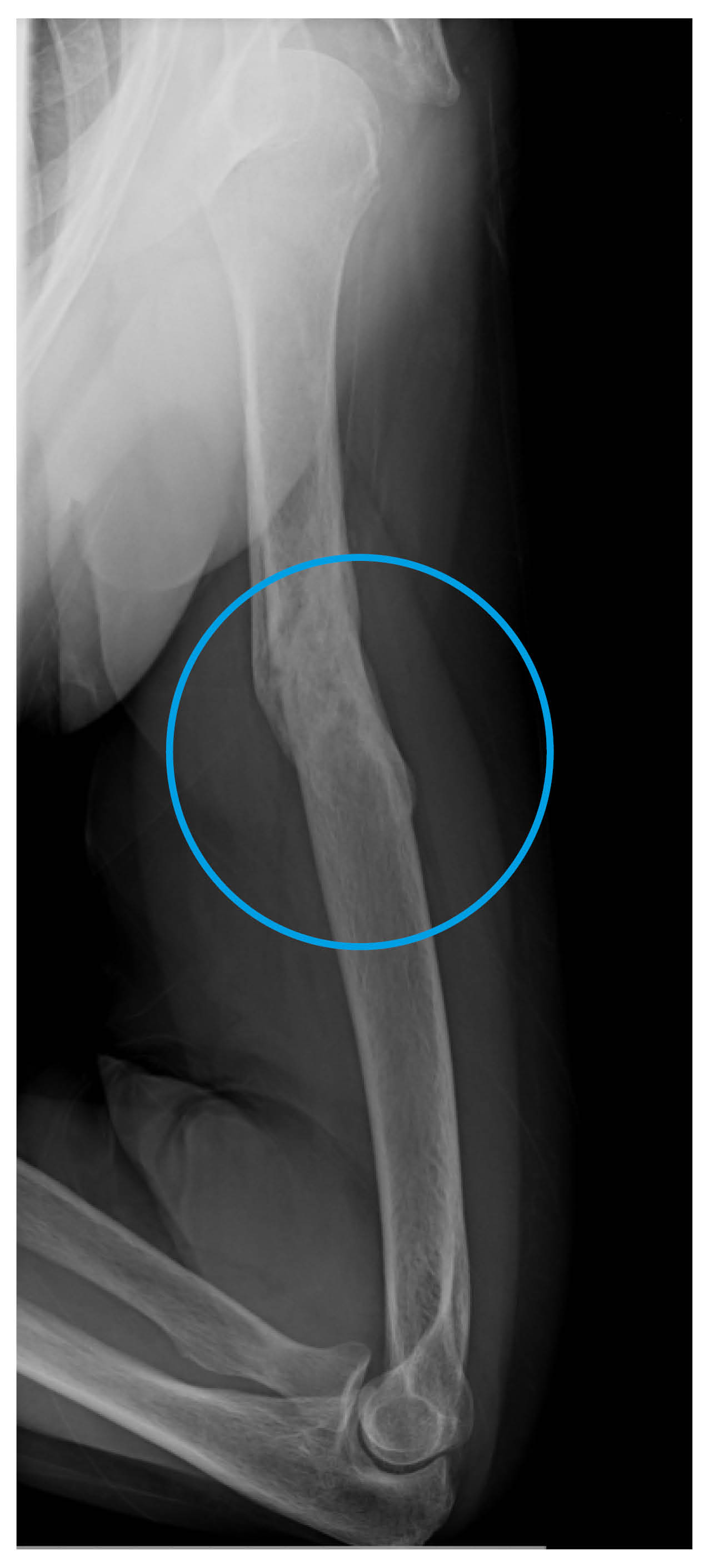 X-ray showing a once fractured humerus bone healed