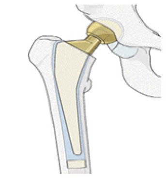 hemi-arthroplasty.jpg