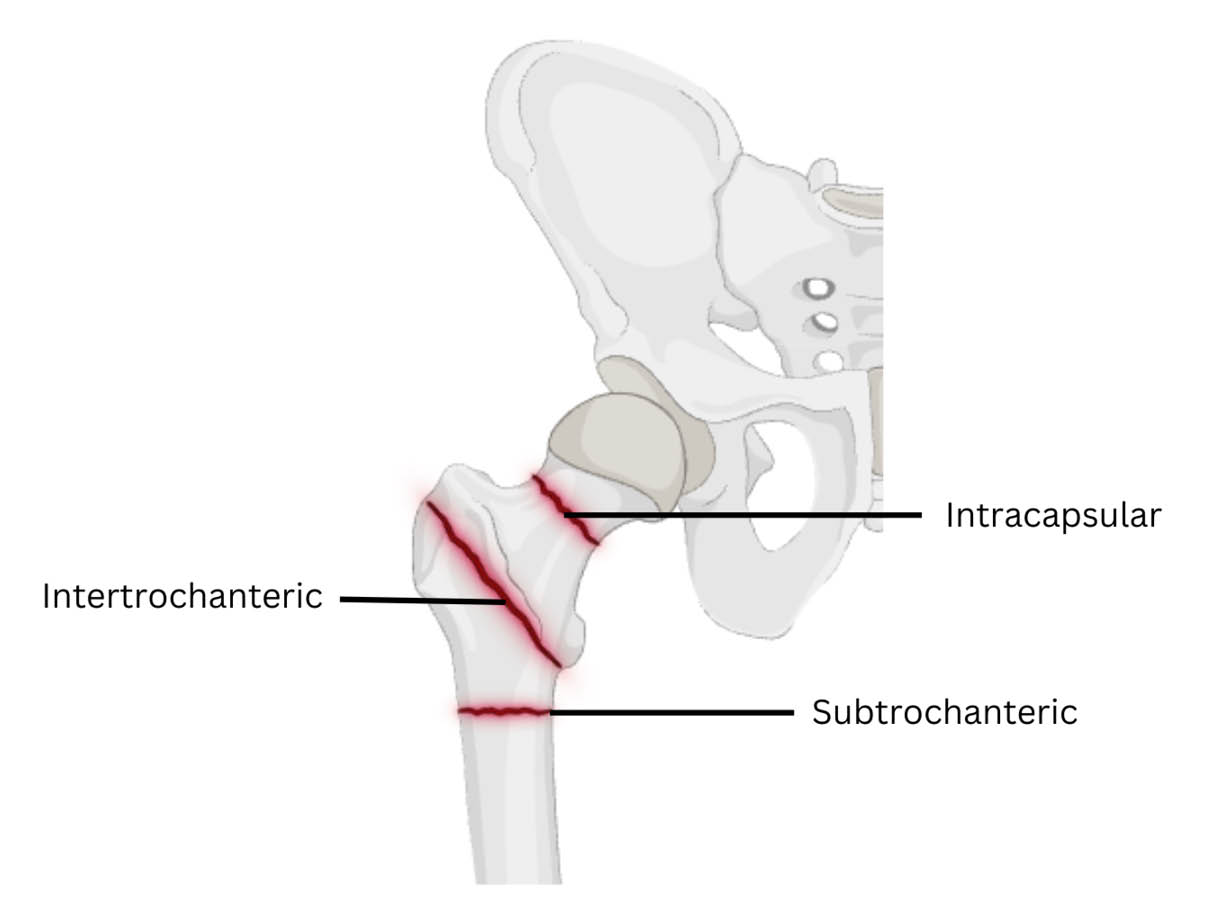 The areas of the femur (intracapsular, intertrochanteric, and subtrochanteric) where different types of fracture commonly occur