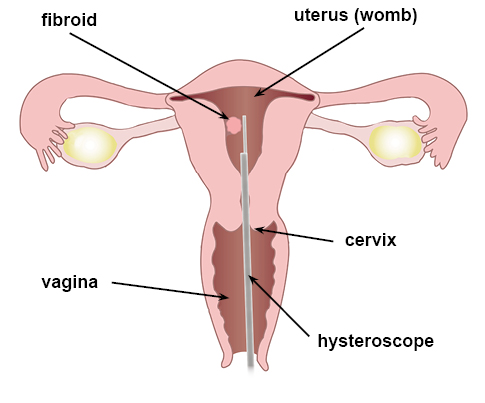 hysteroscope-and-fibroid-1700823970.jpg