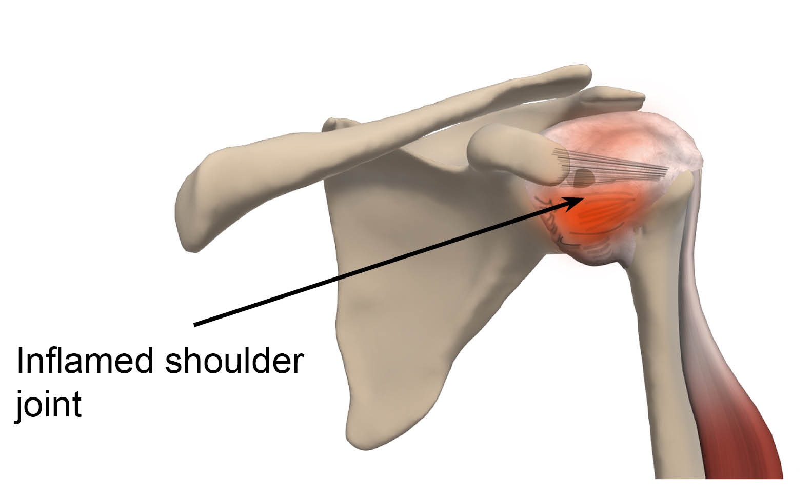 Inflamed (or red) shoulder joint