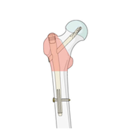 intramedullary-nail-1736846571.jpg