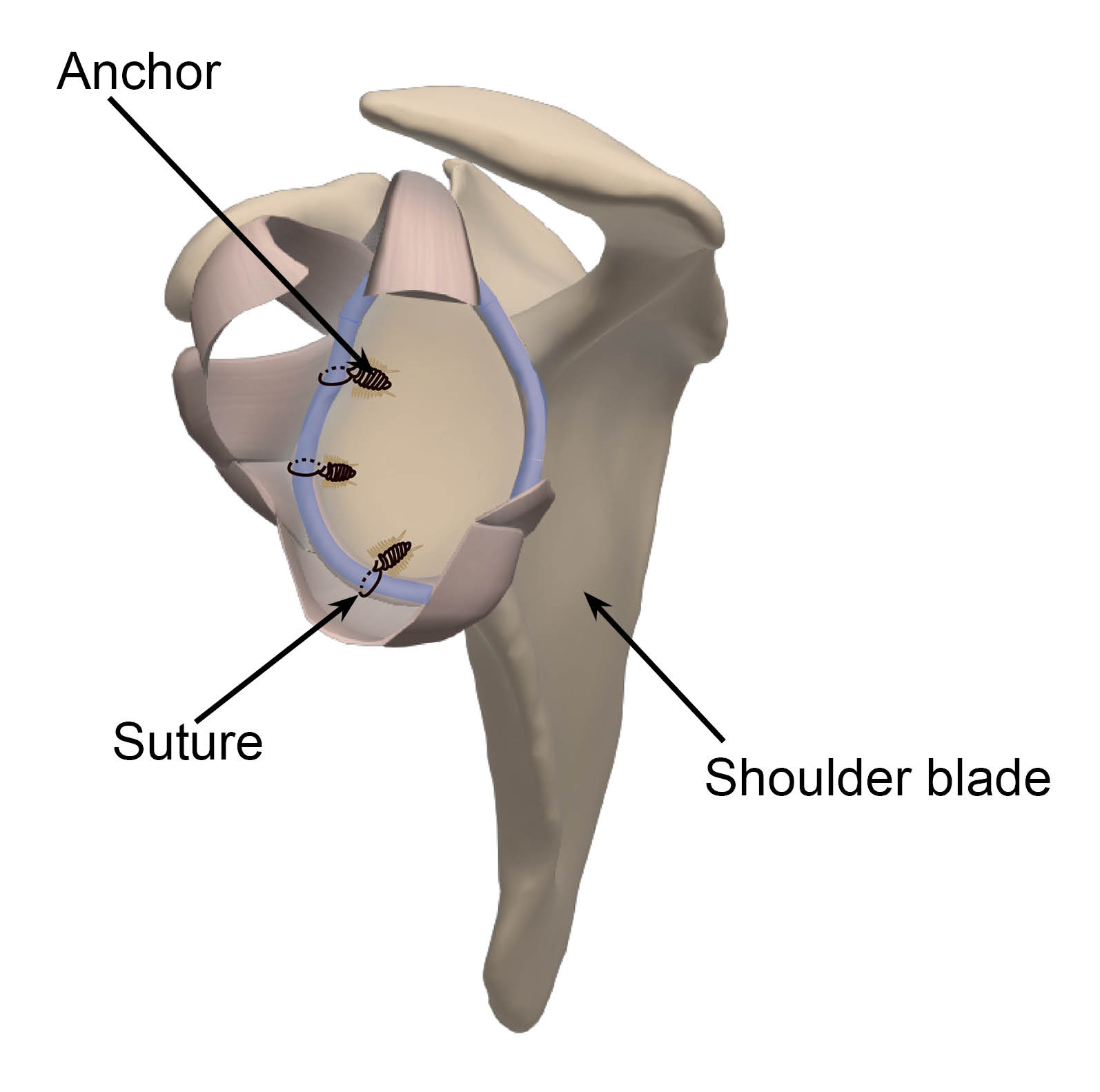 Diagram showing the three tiny anchors and their sutures