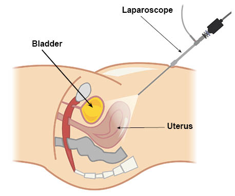 A laparoscope inserted through the navel, showing organs in the pelvis