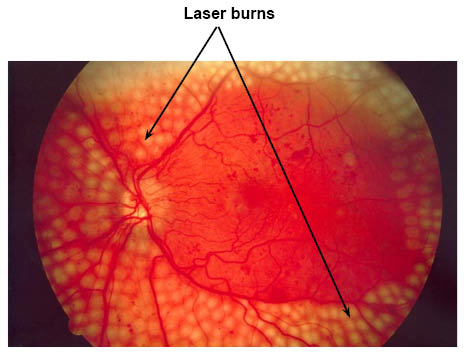 Scan showing laser burns (small circles) on the eye