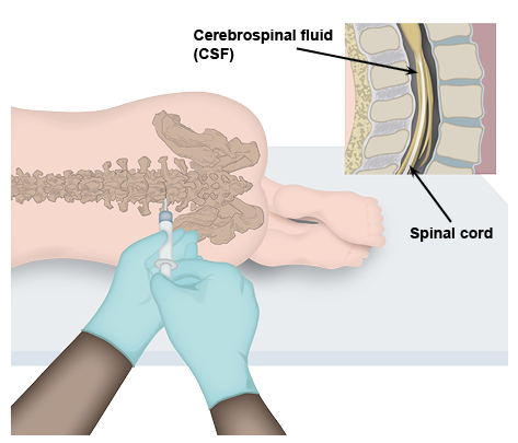 A special needle being used to obtain CSF from the bottom of a child's spine