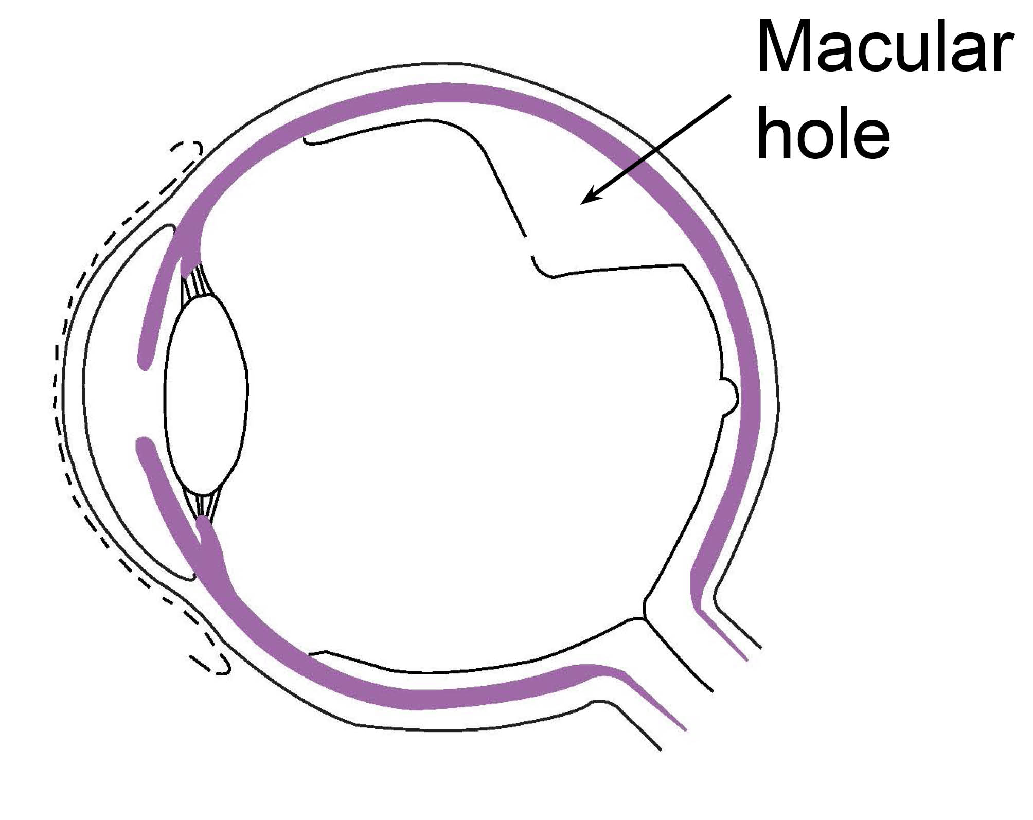 macular-hole-with-labels-1727438235.jpg