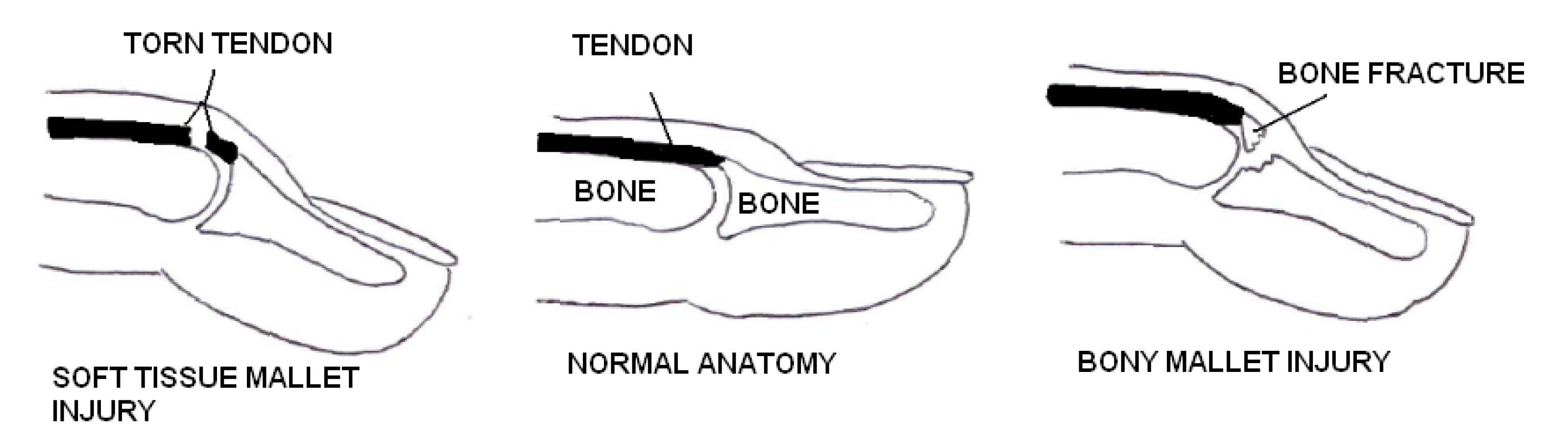 mallet-finger-diagram-hayley-smith.jpg