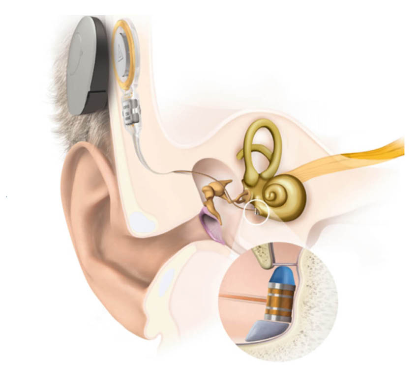 middle-ear-implant-and-processor-1728029786.jpg