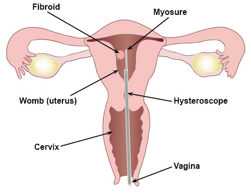 Hysteroscope inserted into the womb through the vaginal opening and cervix. The Myosure device is at the end of the hysteroscope, near the fibroid.