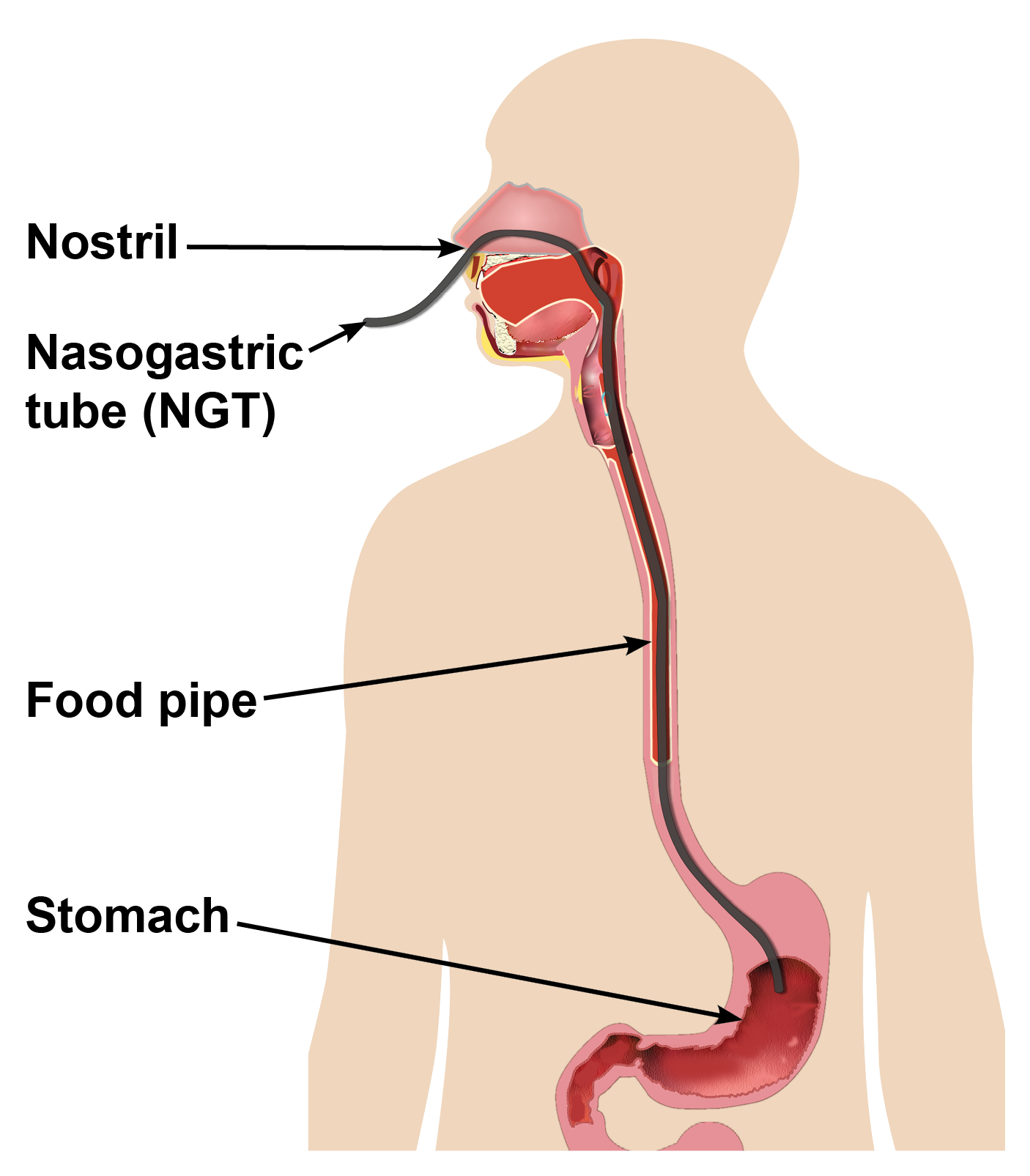 NG tube being inserted through the nostril and into the stomach, via the food pipe