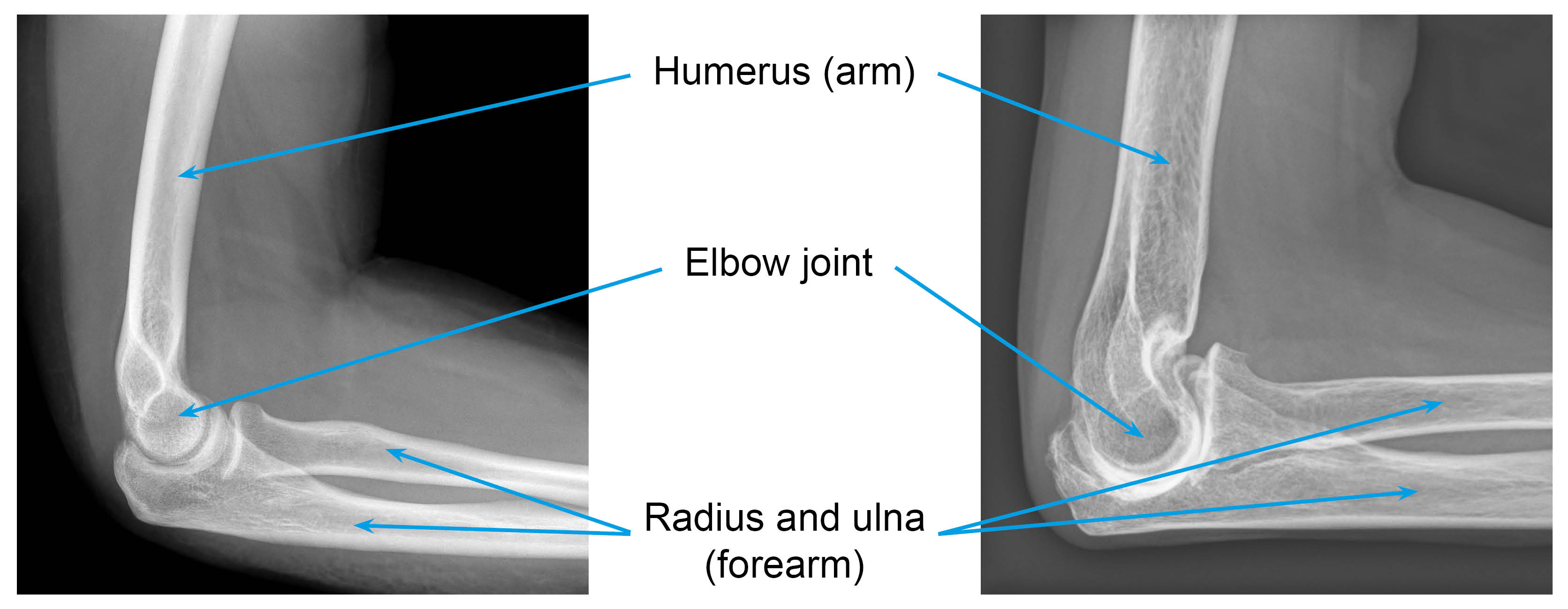 X-ray on left shows a normal elbow joint; X-ray on right shows an elbow with osteoarthritis: decreased joint space and bone growth around the edges of the joint due to wear and tear