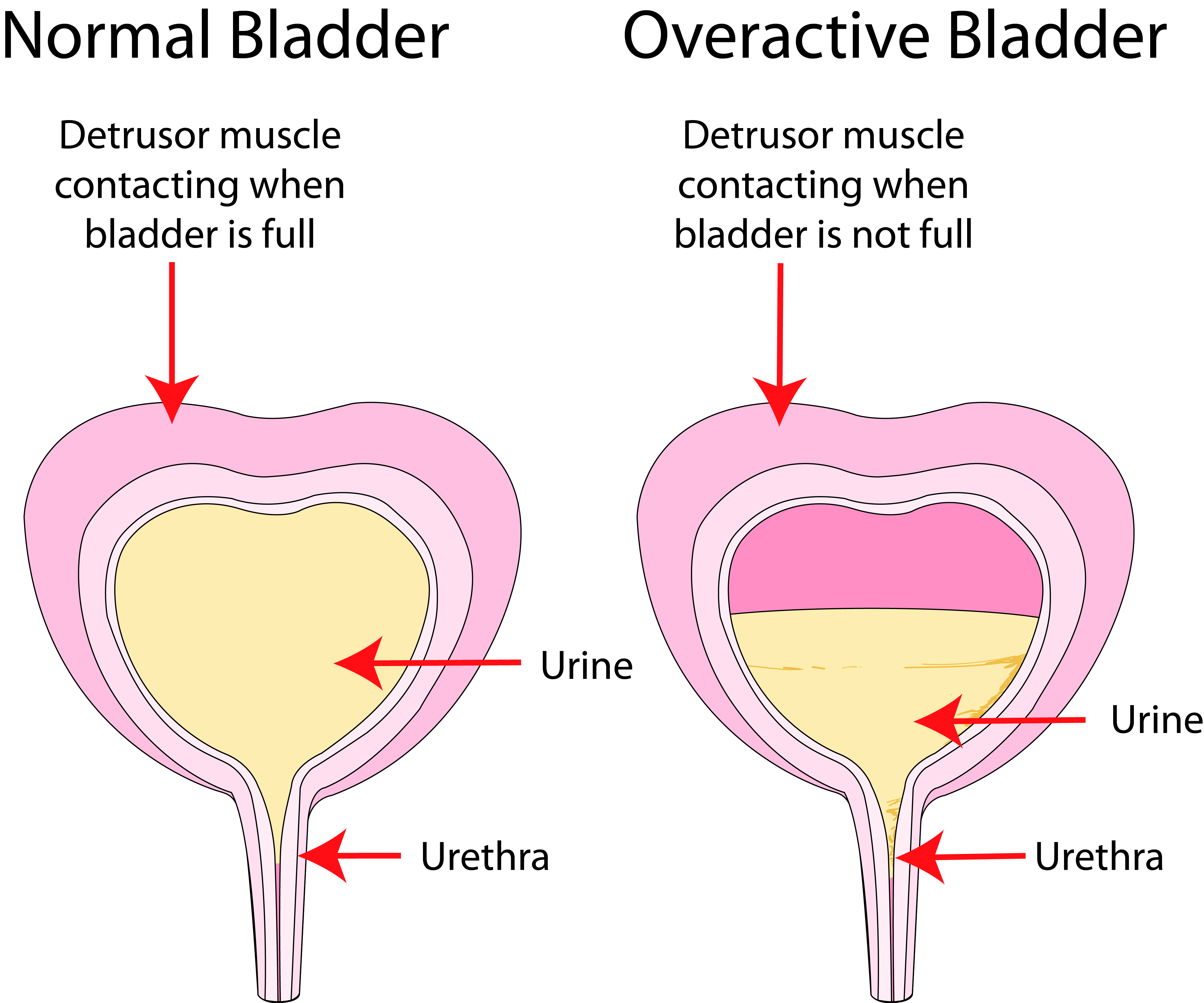 Diagram showing the detrusor muscle contracting when the bladder is not full, causing an overactive bladder.