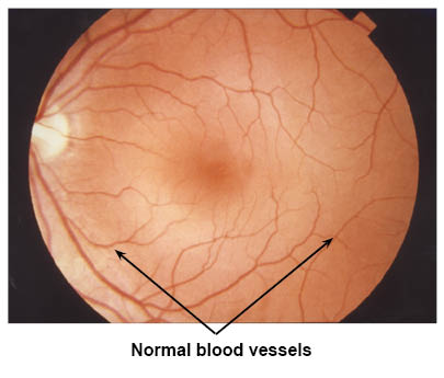 Scan showing normal blood vessels in the eye.