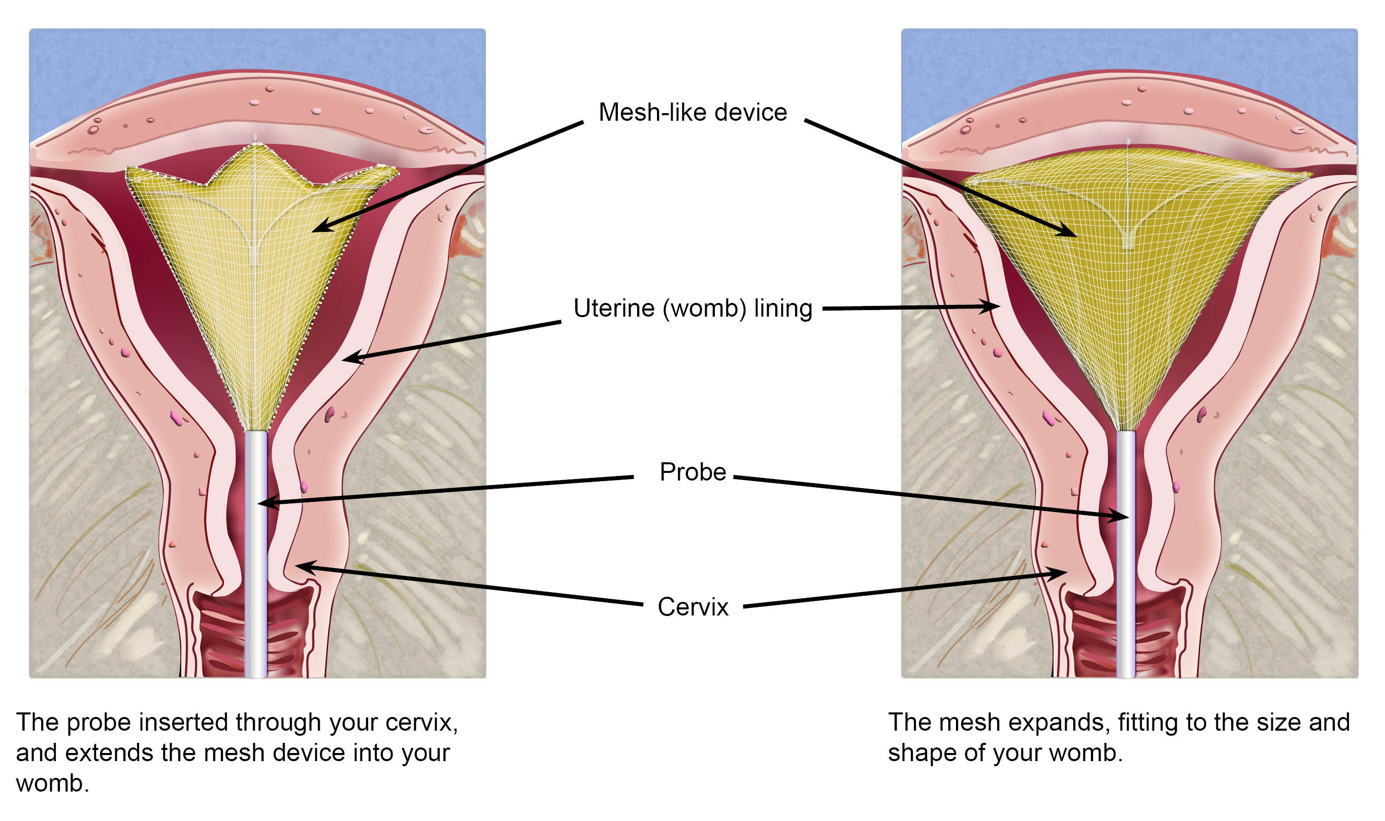 The probe inserted through your cervix, and extends the mesh device into your womb. The mesh expands, fitting to the size and shape of your womb.