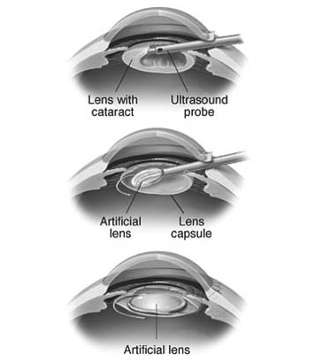 Diagram showing how the artificial lens is applied
