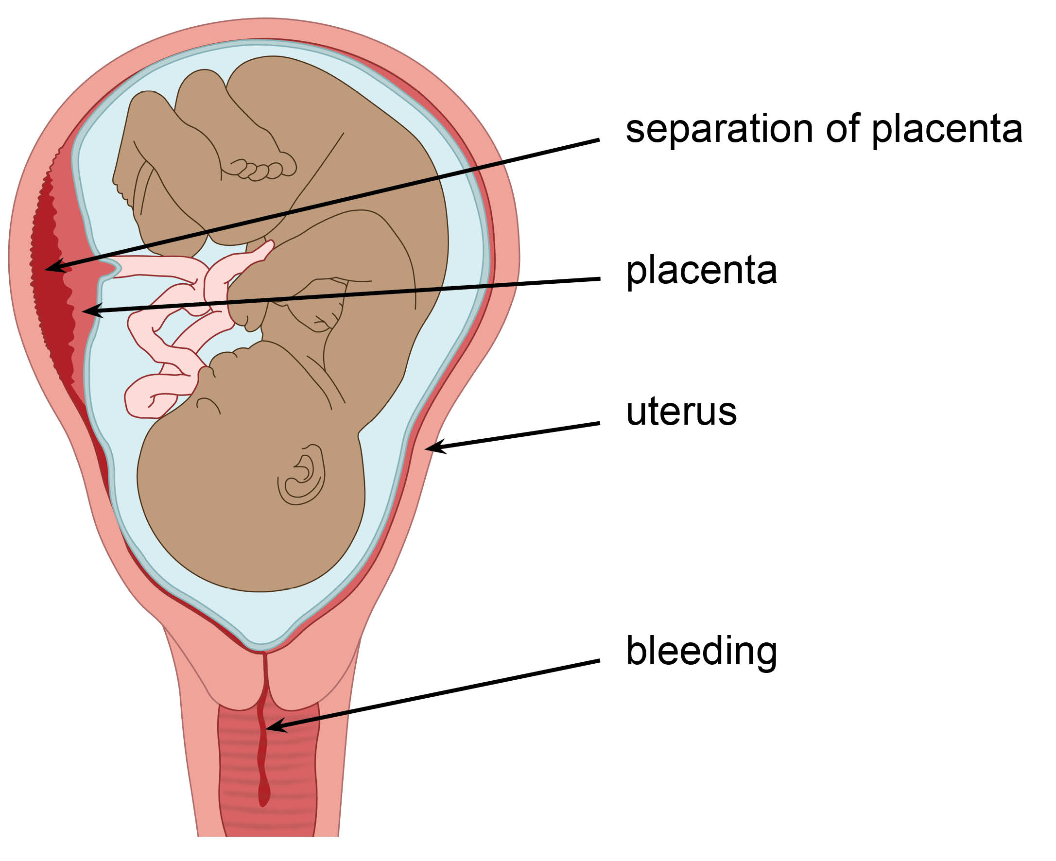 Diagram showing a placental abruption, the placenta separating from the uterus