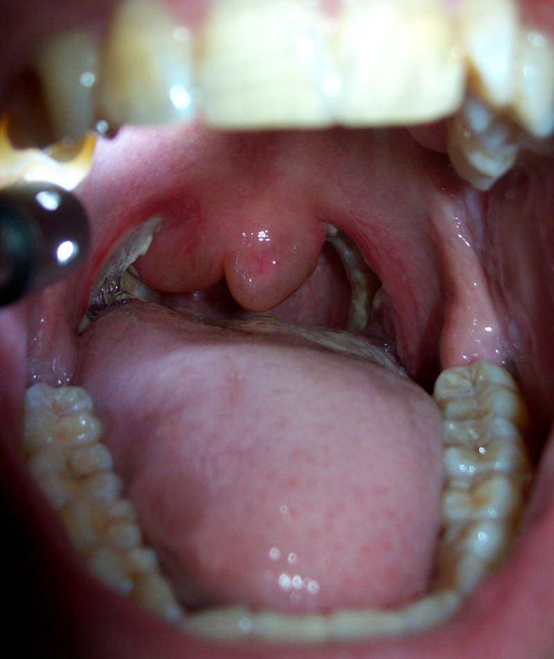 post_tonsillectomy_uvula_swelling.jpg