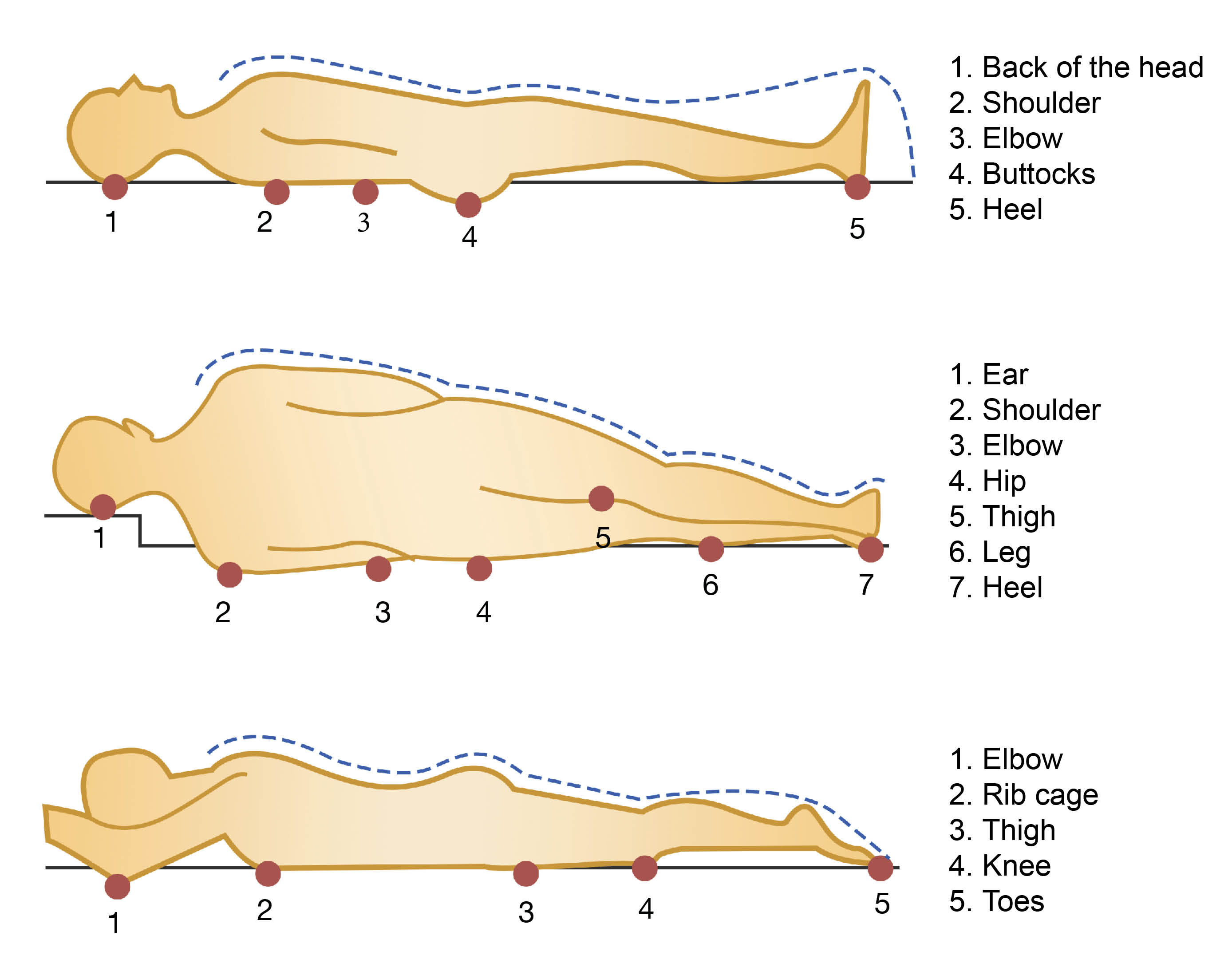 When laying down, the points on the body where a patient is at risk of developing a pressure ulcer