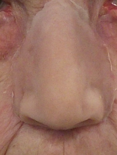 prosthetic-nose-medphoto.png