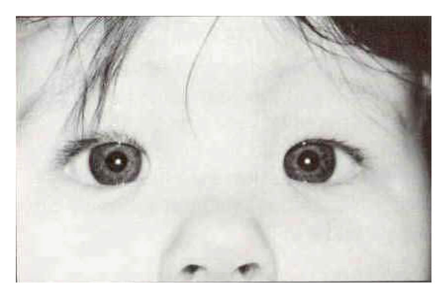 Photo of child with pseudostrabismus. It looks like the eye turns in but it doesn't as the white dots are in the centre of each eye.