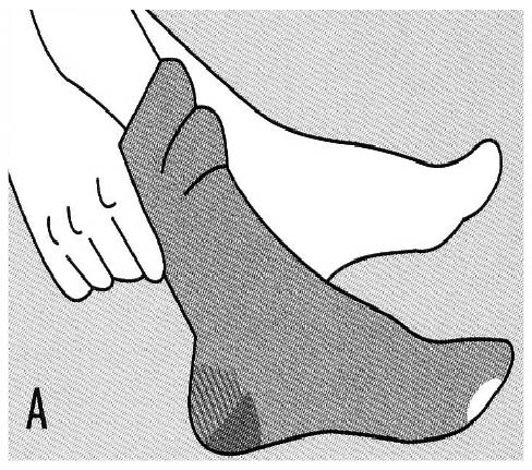 Diagram showing putting the stocking over your ankle and easing the fabric up your leg, avoiding dragging the stocking against your skin
