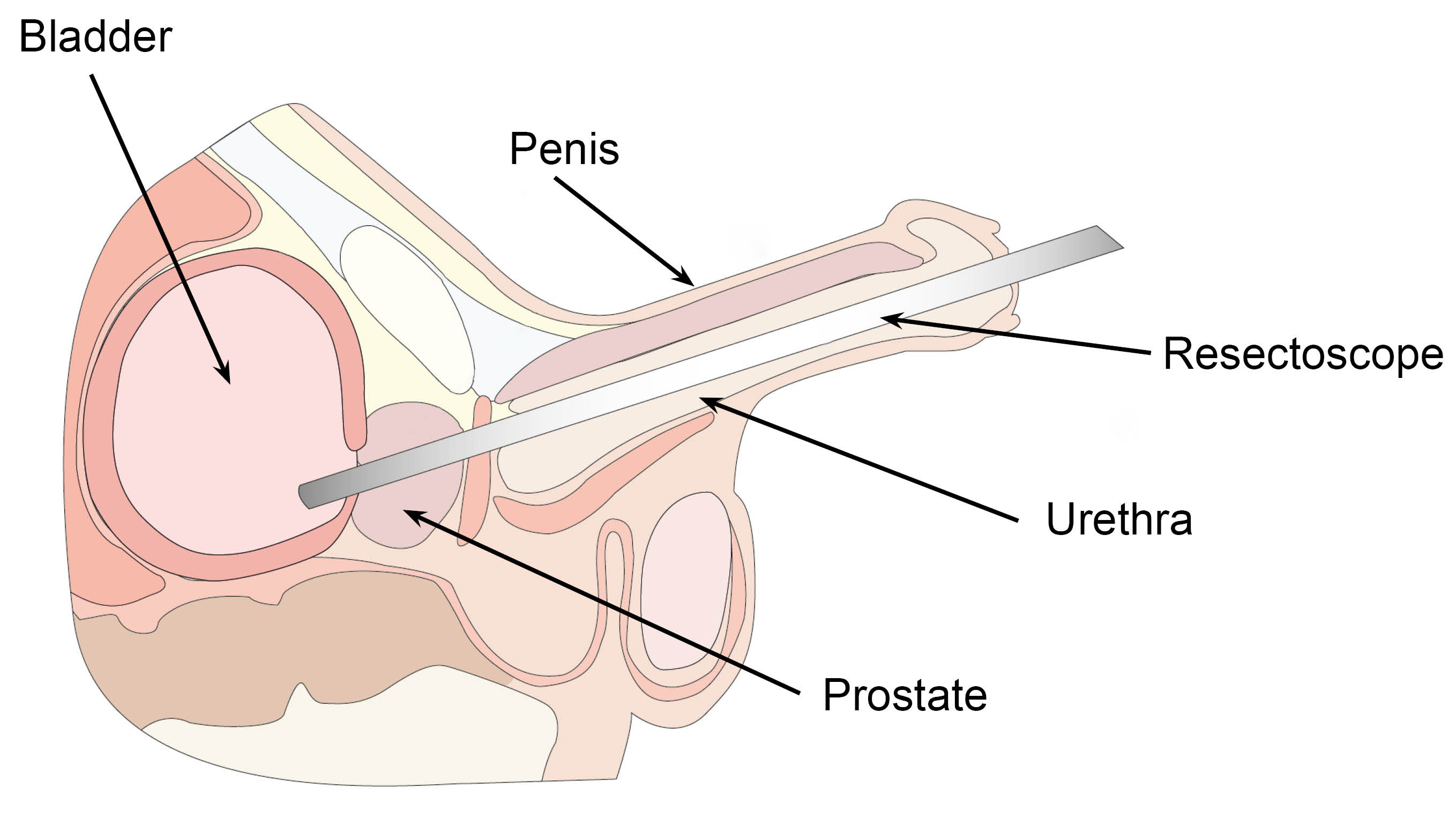 rectoscope-and-prostate-1723718900.jpg