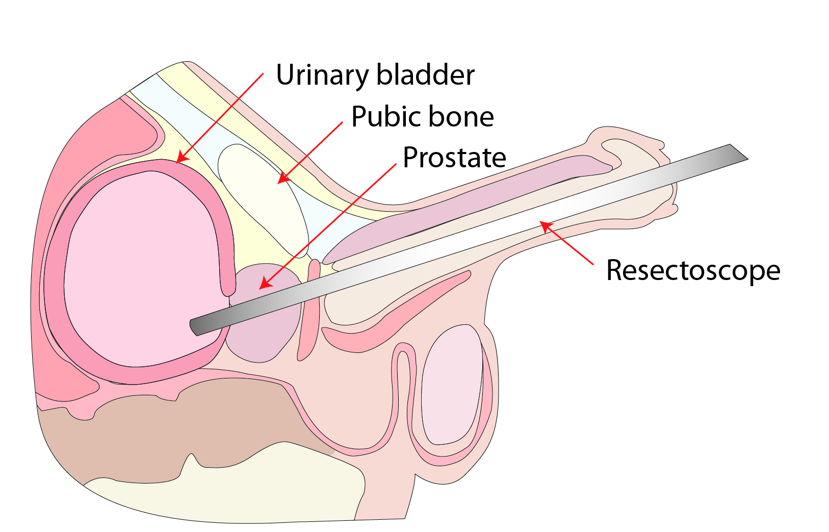 Resectoscope being passed up into the male urethra