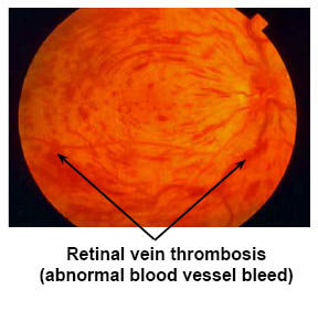 Retinal vein thrombosis (abnormal blood vessel bleed)
