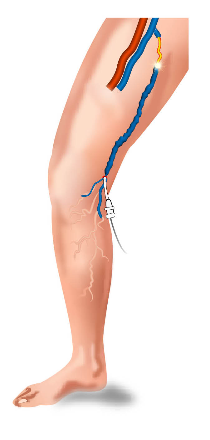 Disposable catheter inserted into greater saphenous vein