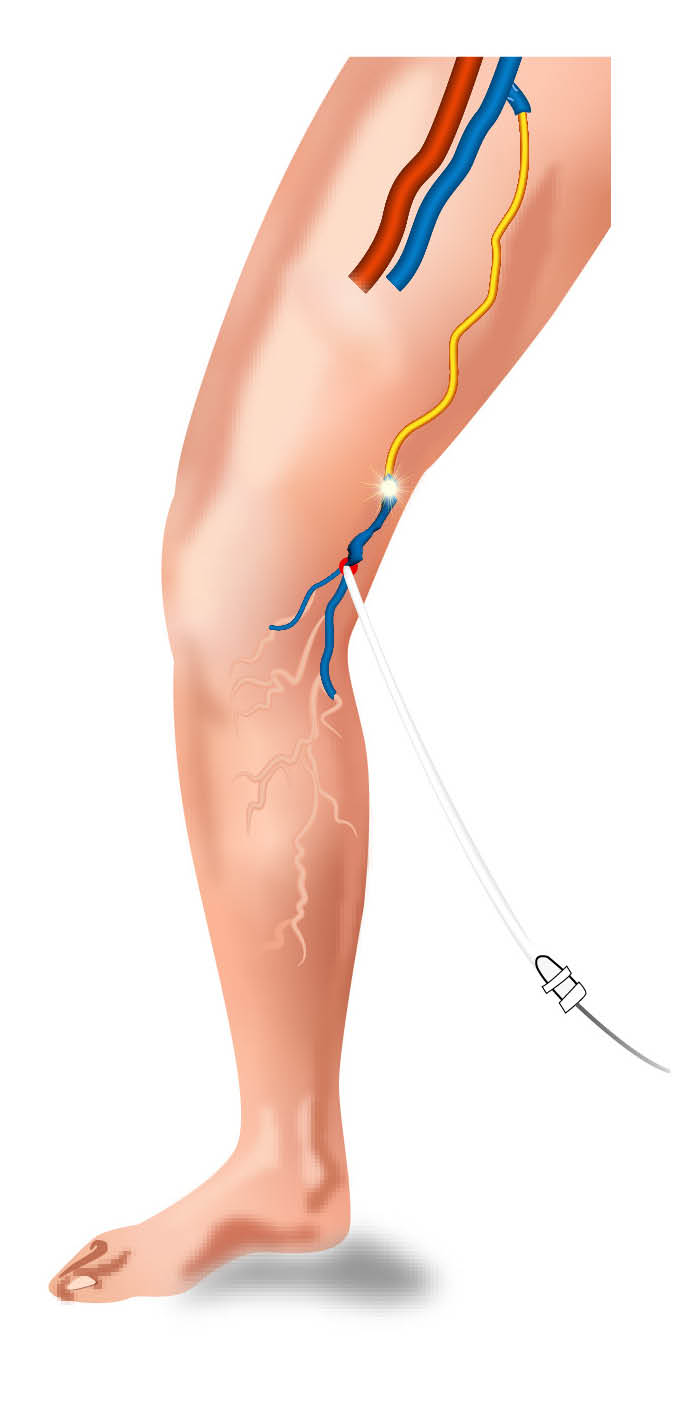 Catheter withdrawn, closing vein