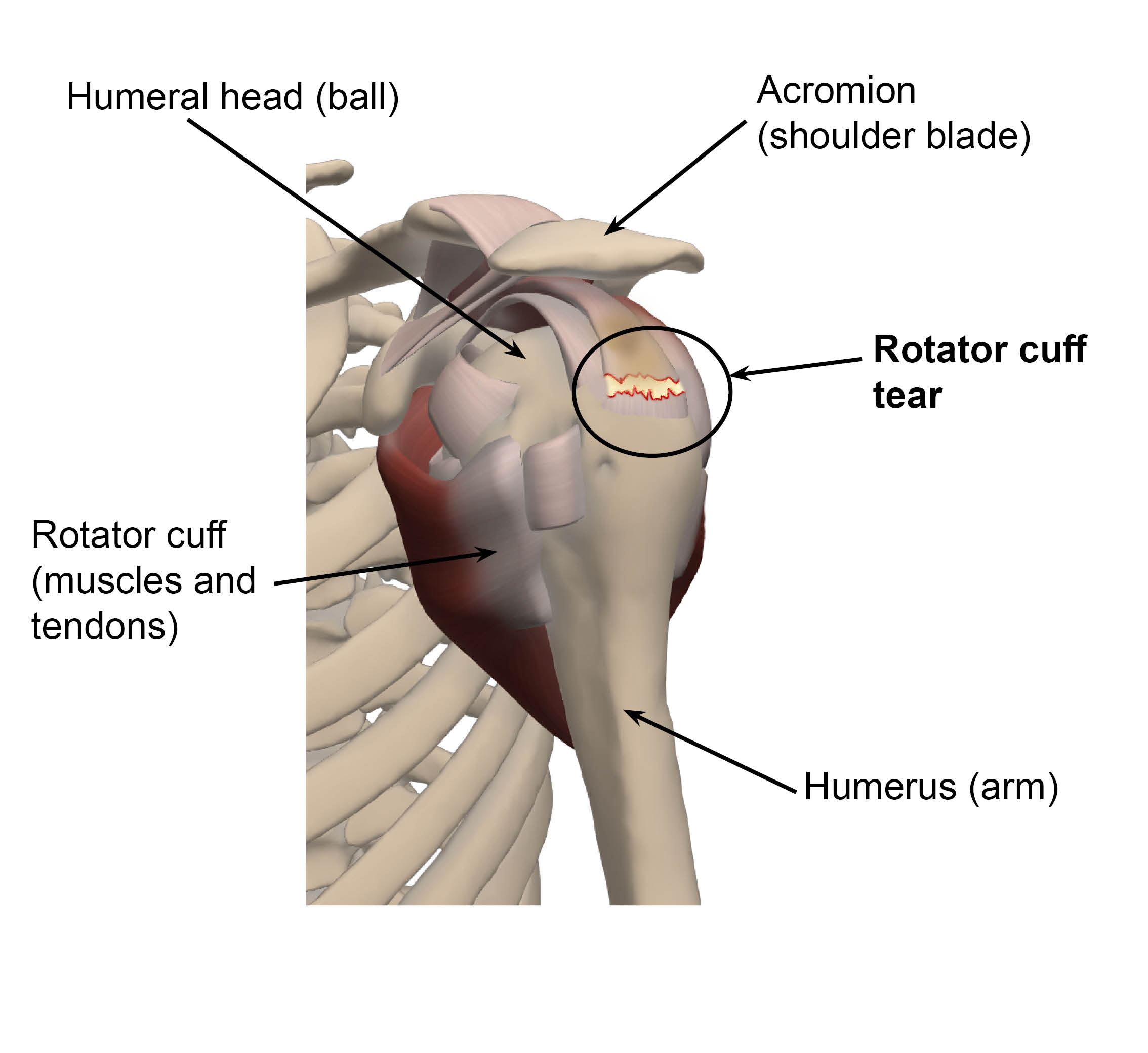 A diagram showing a tear in the rotator cuff