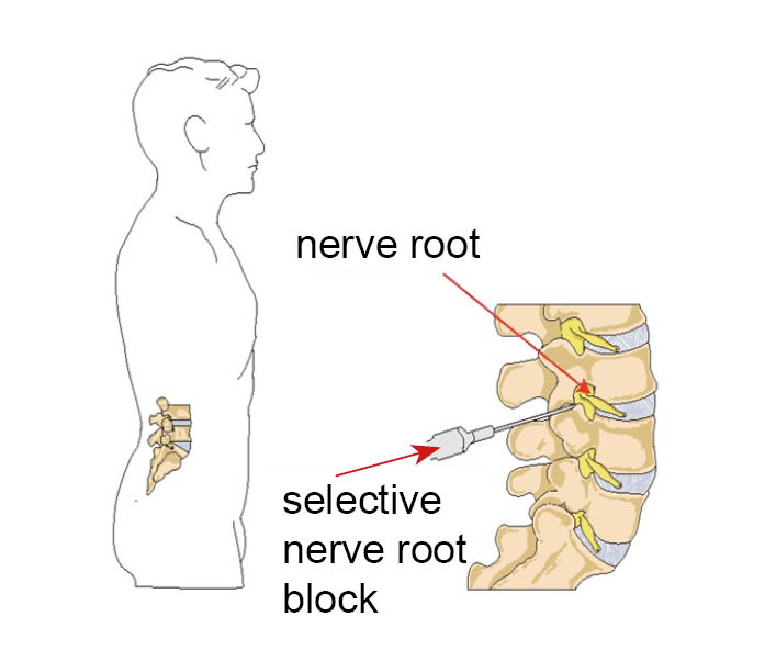 Nerve roots, and a selective nerve root block being administered