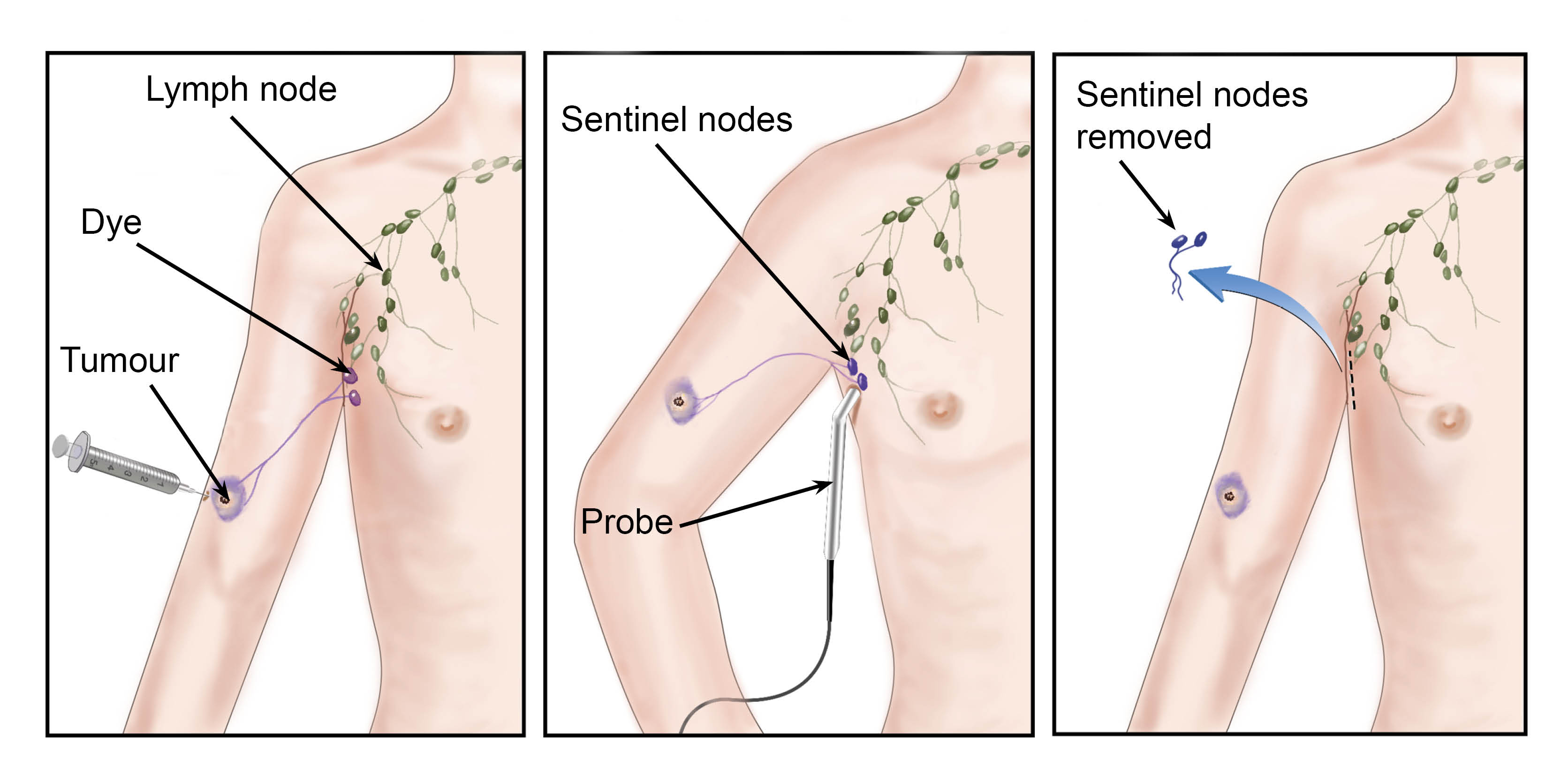 A sentinel lymph node biopsy