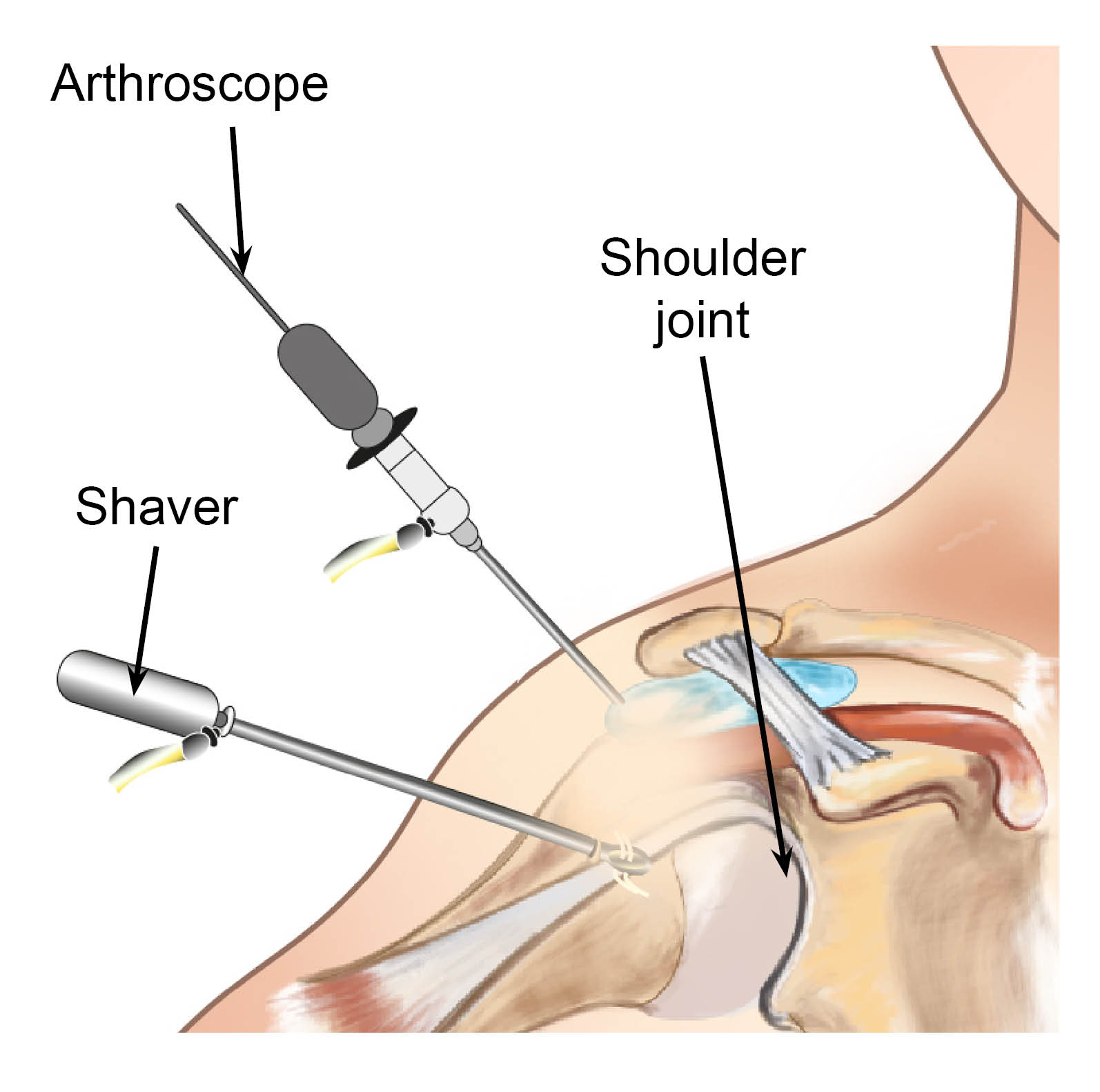 Diagram showing keyhole surgery, using an arthroscope and shaver