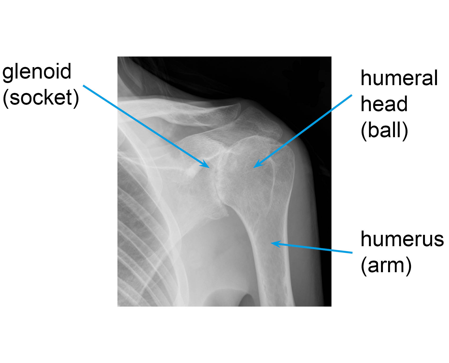 X-ray showing a shoulder with osteoarthritis: decreased joint space and bone growth around the edges of the joint due to wear and tear