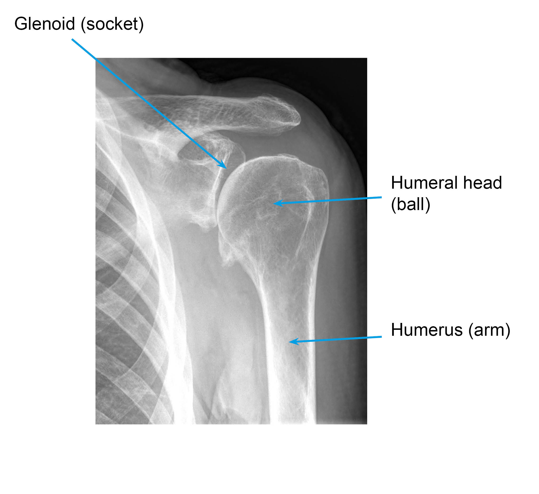 X-ray showing a shoulder with osteoarthritis: decreased joint space and bone growth around the edges of the joint due to wear and tear