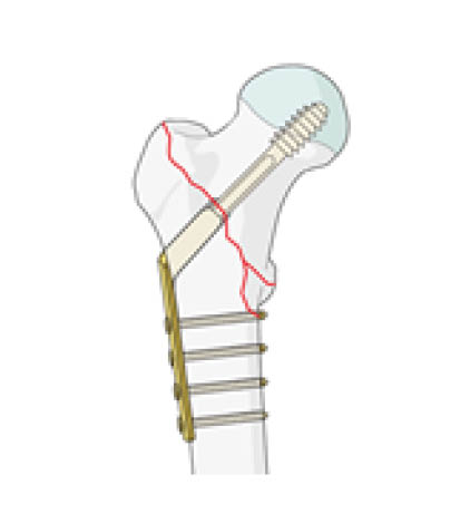 sliding-hip-screw.jpg