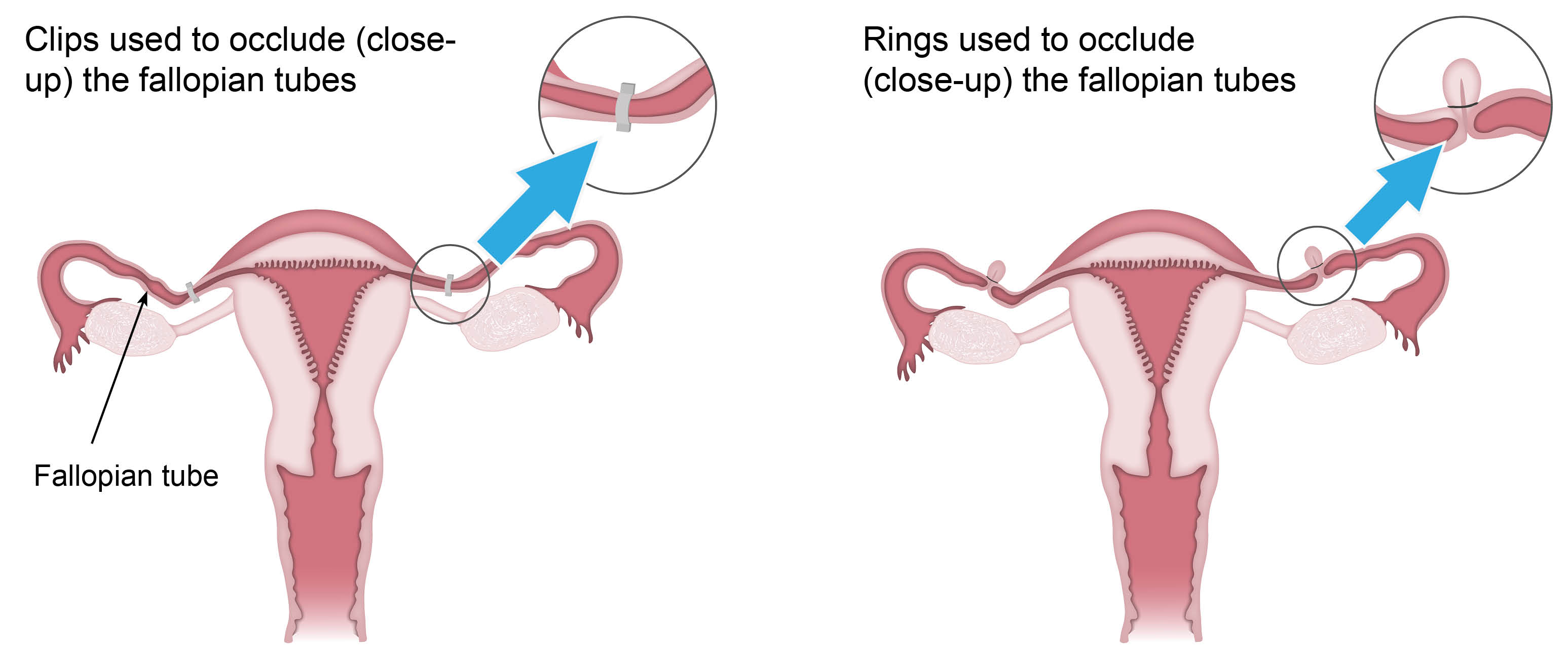 Clips or rings attached to each fallopian tube, closing the tube.