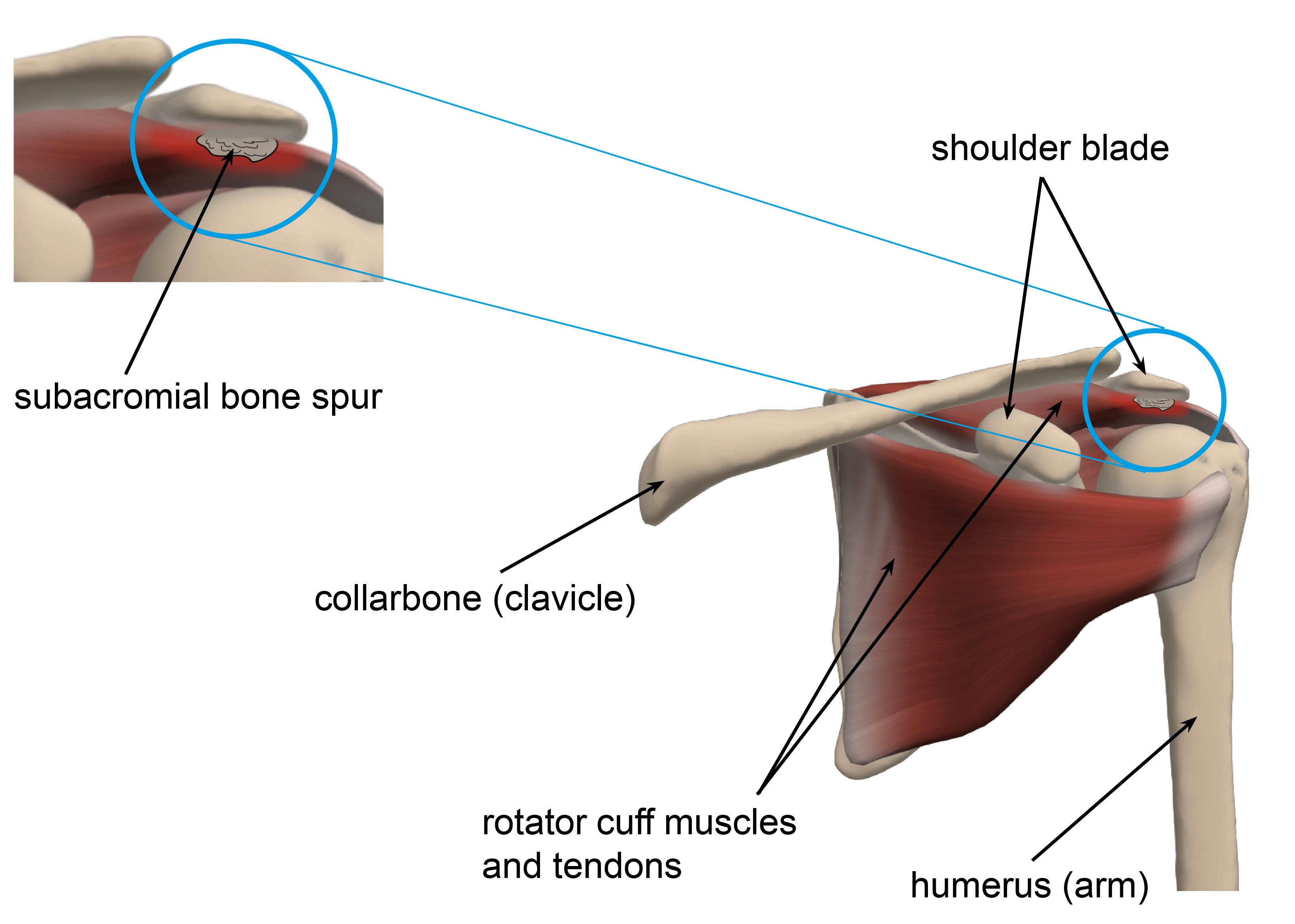 Diagram showing a subacromial bone spur