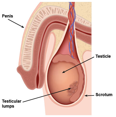 Diagram showing the penis, testicle, and scrotum, with lumps in the testicle.