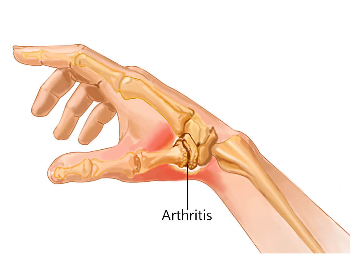 Diagram showing a side view of the bones and joints of the thumb, and arthritis developing in the base of the thumb.