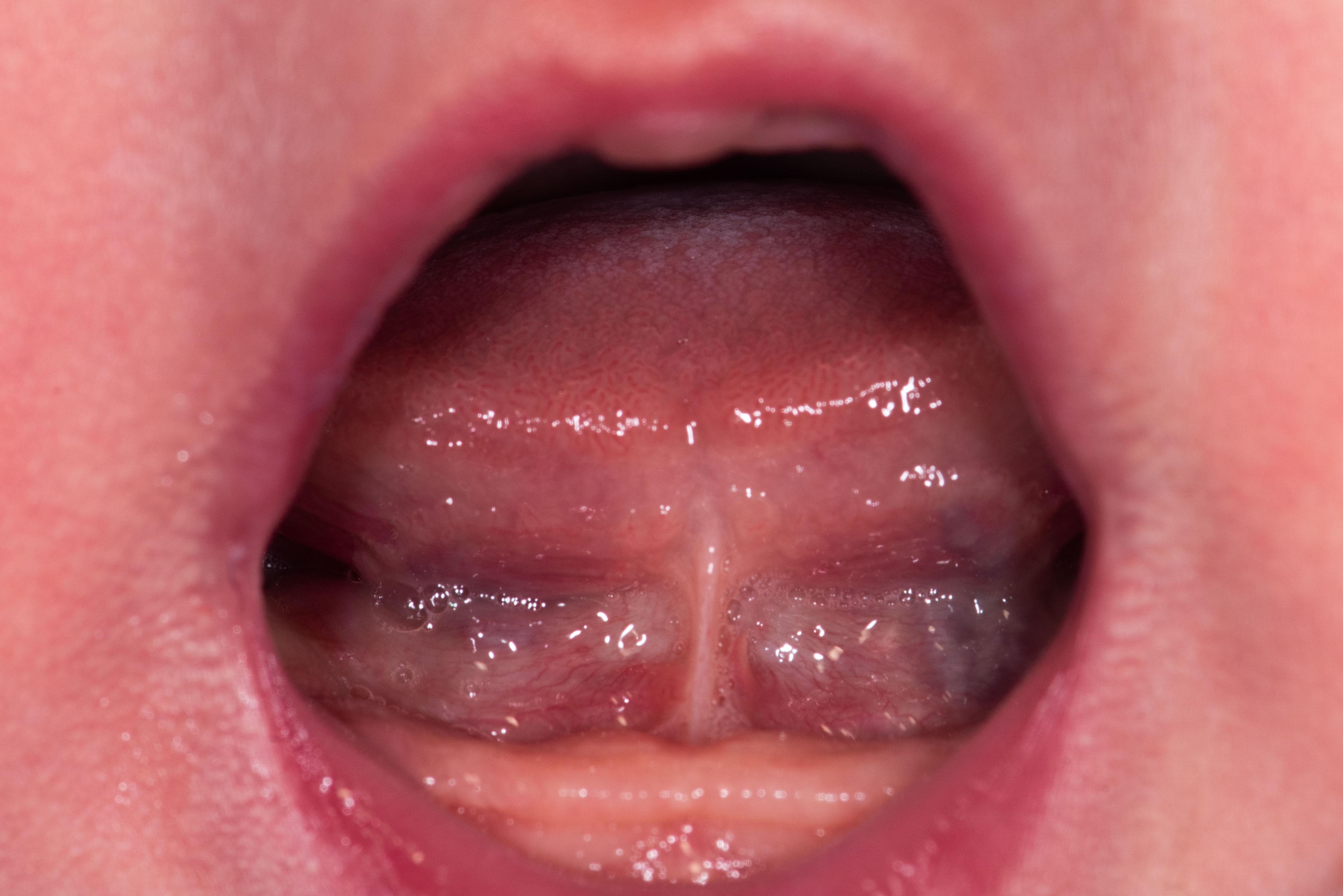 Anterior tongue-tie