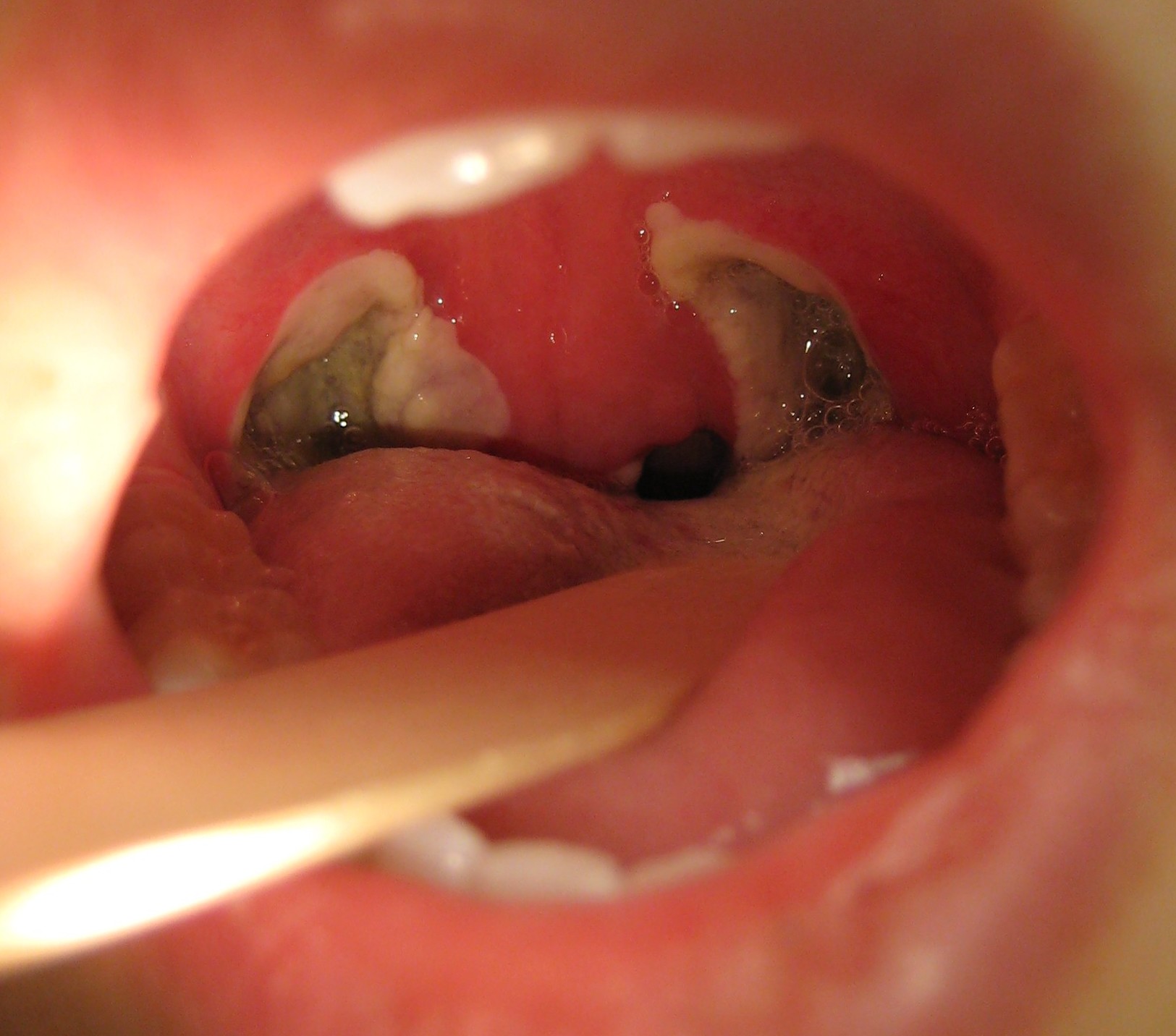 tonsillectomy09-(1).jpg