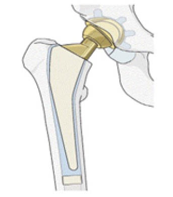 total-hip-replacement.jpg